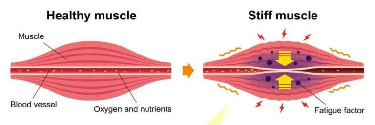 Cause of tightness and pain stiffness